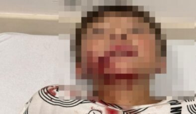 Alanya’da sokak köpeğinin saldırısına uğrayan çocuk yaralandı